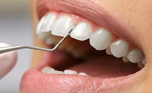 نقش زاویه فیشور در شکست لایه مینای دندان