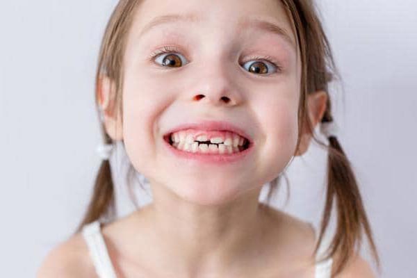 آیا همه افراد در معرض پوسیدگی فیشور هستند؟