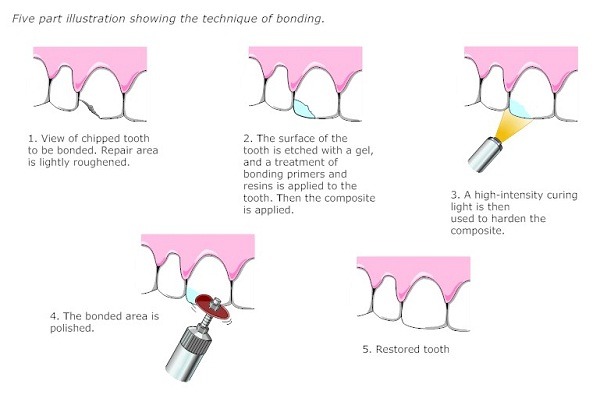 اسید اچ دندانپزشکی در آموزش و تجربه